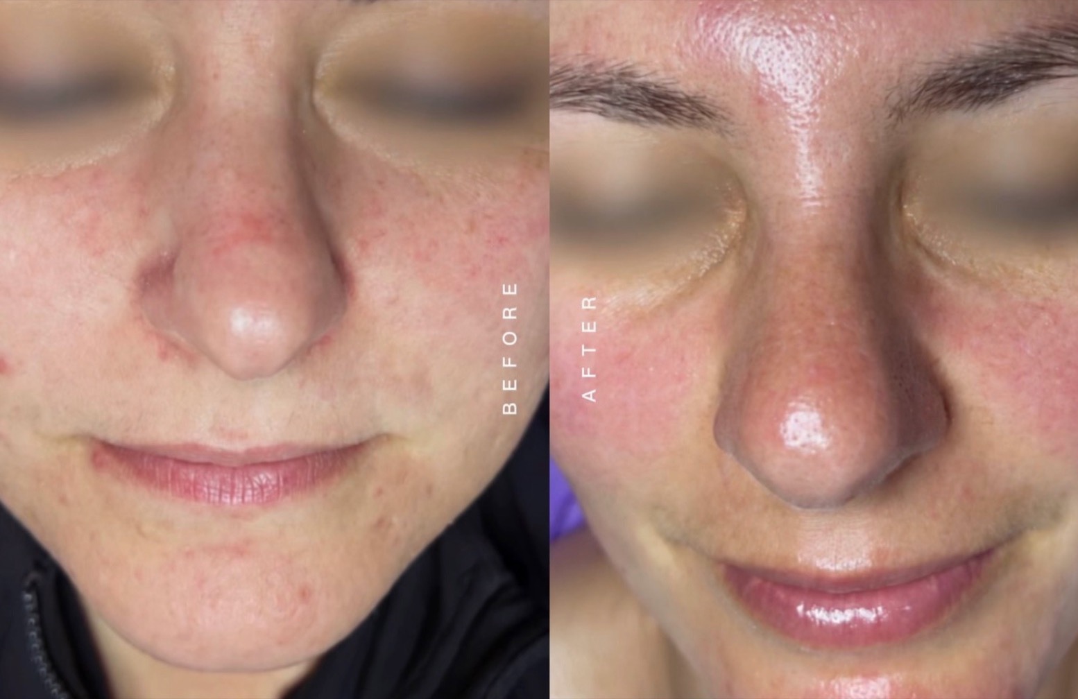 Before and after facial treatment: calmer skin with less redness and fewer blemishes