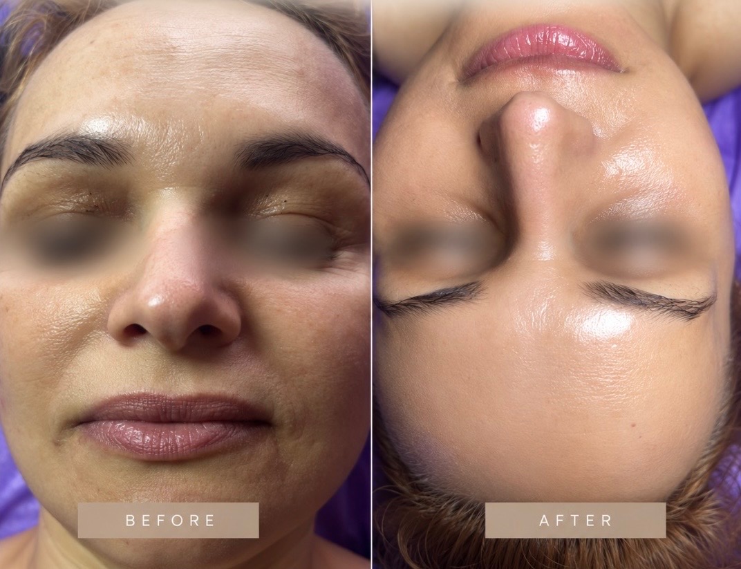 Before and after facial treatment: brighter, smoother, more hydrated skin