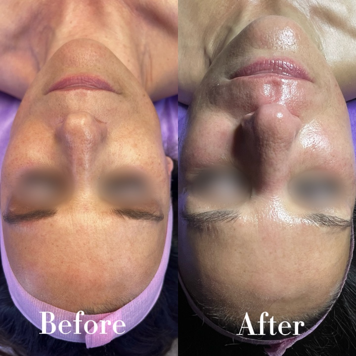 Before and after facial treatment: a more even, radiant complexion