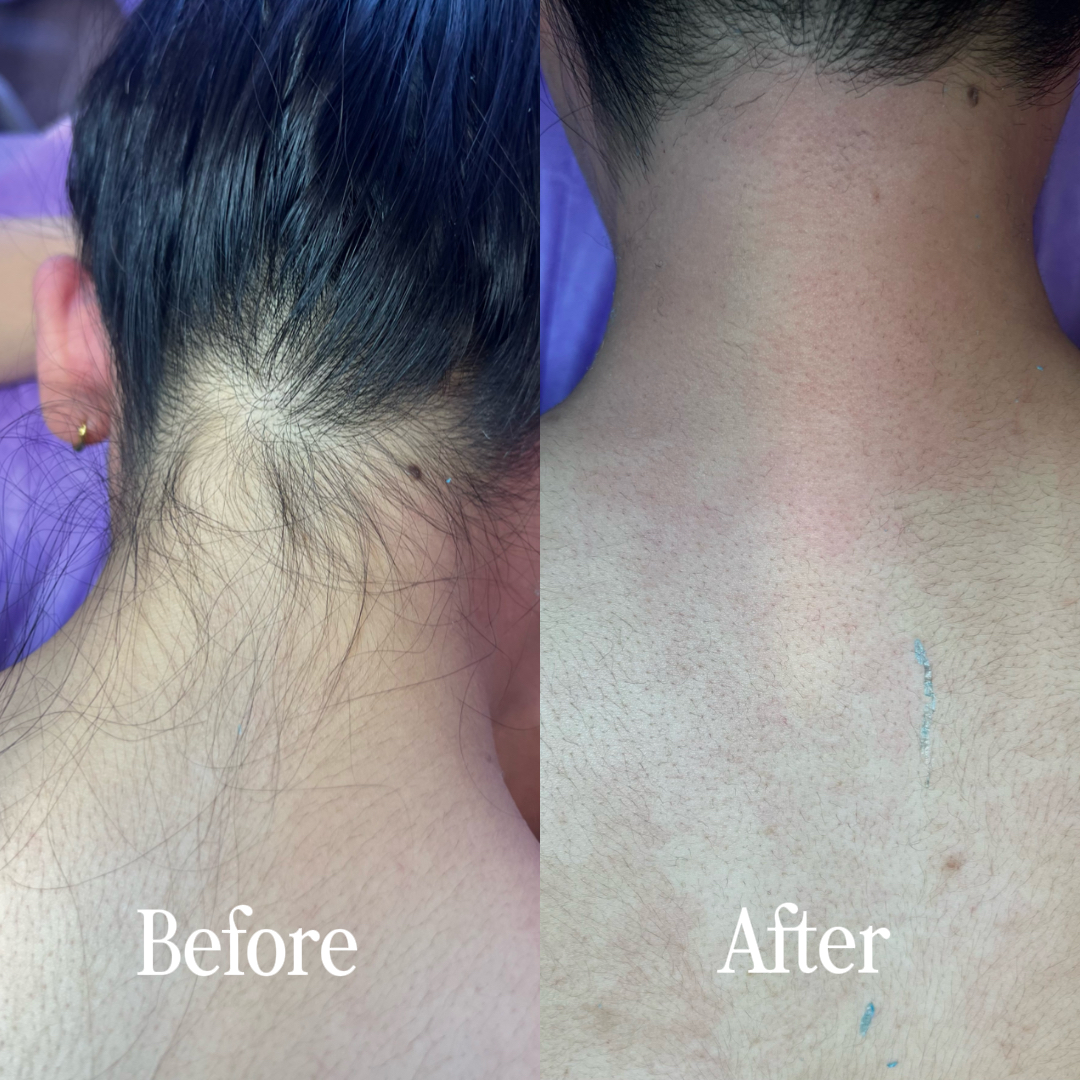 Before and after hairline and neck waxing